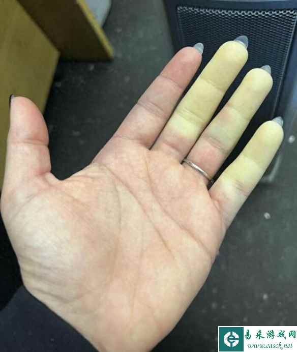 天生双拇指、重瞳、精灵耳朵！30个神奇的基因携带者